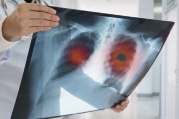 「肺がんの新たな敵、肺胞マクロファージの正体とは？―大阪大学の研究者らが衝撃の事実とその機構を紐解く」記事内の画像