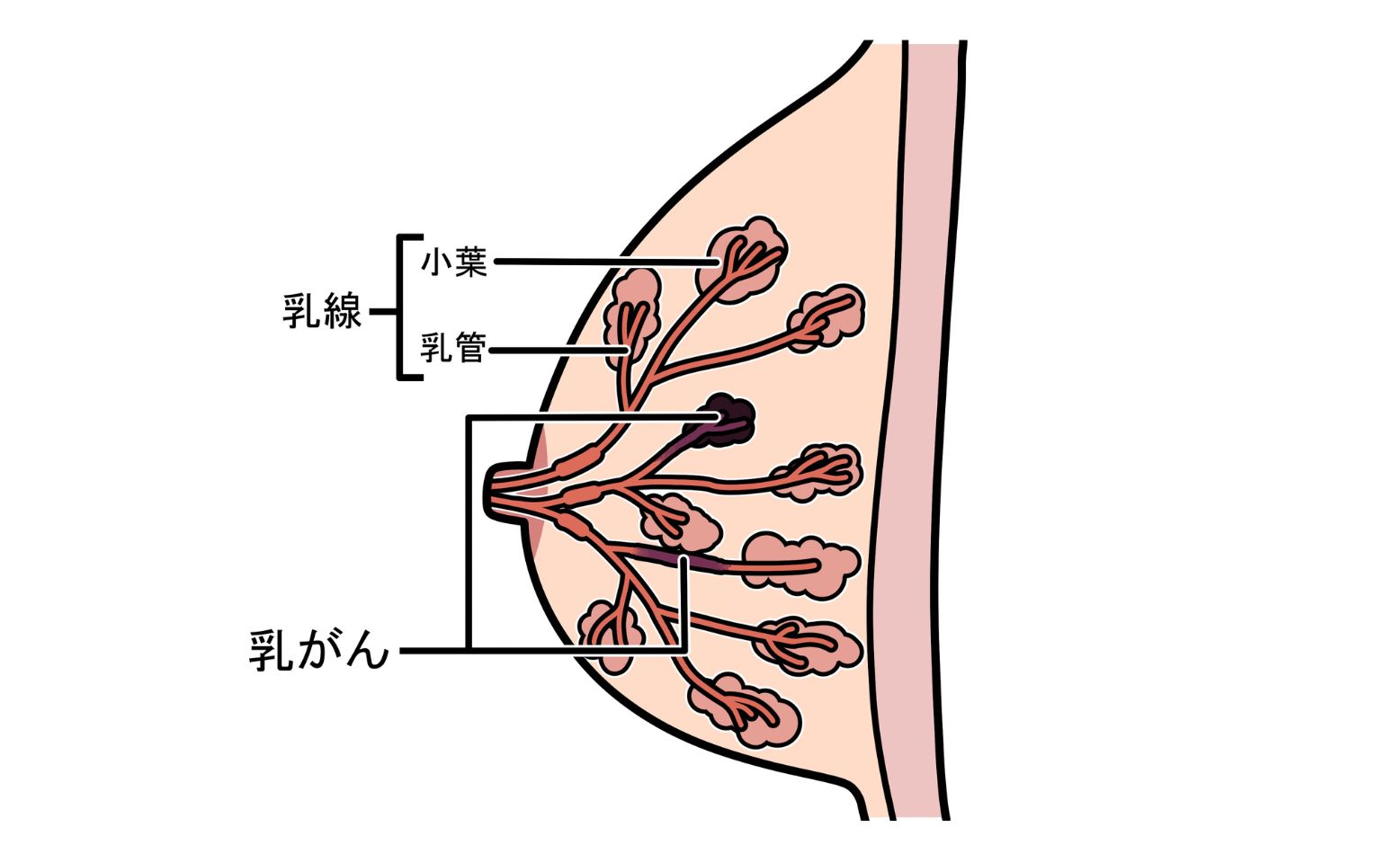 浸潤性小葉がんとは？のイメージイラスト