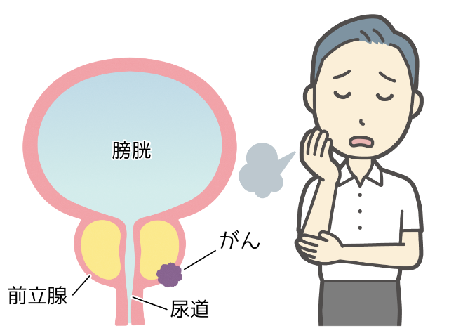 前立腺がん　免疫療法