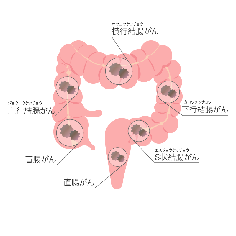 直腸がん