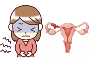 「卵管がんのステージ4の症状とは? ステージ別特徴や治療法まで詳しく解説」記事内の画像