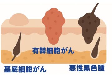 「皮膚がんの転移とは？　症状や治療法について解説」記事内の画像