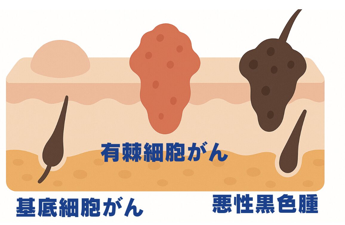 皮膚がんとは