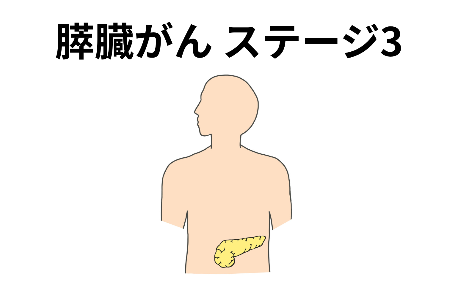 膵臓がんステージ3
