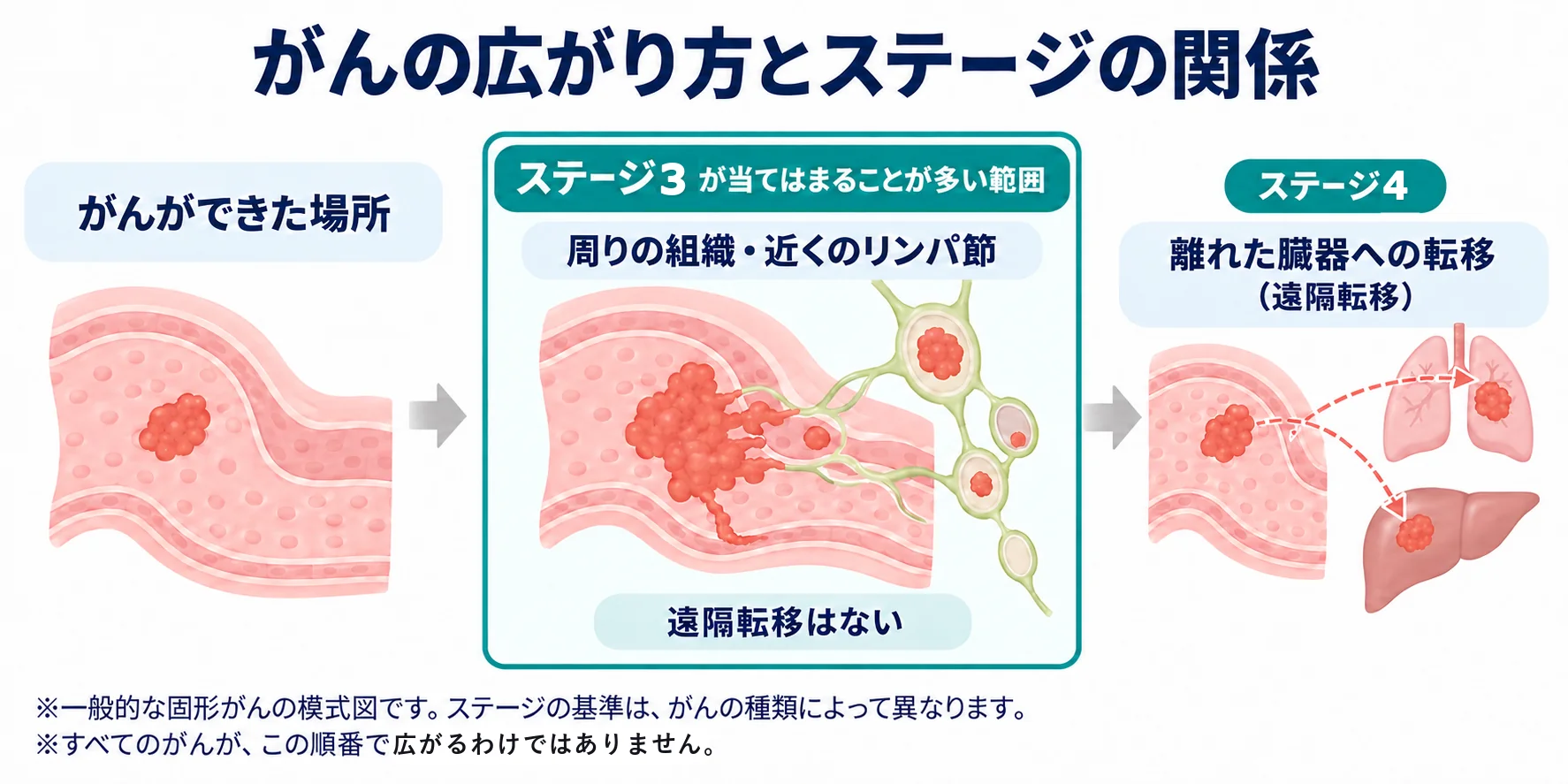 がんの広がり方とステージの関係を示す模式図。がんが周りの組織や近くのリンパ節まで広がり、遠隔転移がない段階はステージ3が当てはまることが多く、離れた臓器への転移（遠隔転移）があるとステージ4になります。