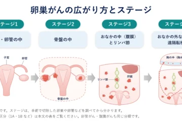 「卵巣がんのステージ分類とは？ステージ1〜4の違いと治療の流れ」記事内の画像