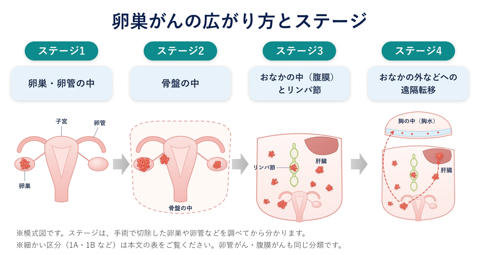 卵巣がんのステージ1〜4の広がり方の模式図。ステージ1は卵巣・卵管の中、ステージ2は骨盤の中、ステージ3はおなかの中（腹膜）とリンパ節、ステージ4はおなかの外などへの遠隔転移がある段階です。