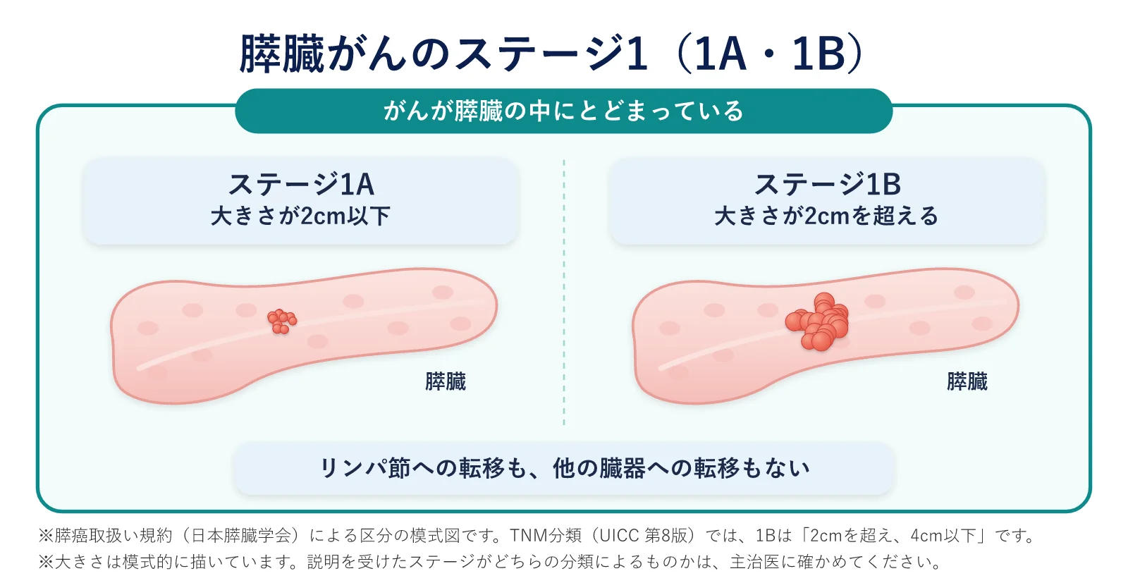 膵臓がんのステージ1の模式図。ステージ1は、がんが膵臓の中にとどまり、リンパ節や他の臓器への転移がない段階で、膵癌取扱い規約では、がんの大きさが2cm以下なら1A、2cmを超えると1Bです。